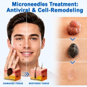 ✨Curalona® 2-in-1 Microneedle & Hydrocolloid Patch🍀 | Removes raised moles, acne, flat warts, and skin tags | Helps improve wrinkles, scars, and blemishes | Invisible patches for face and body